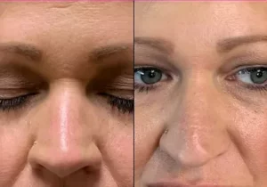 Botox Before and After Result at Kim Bell MedSpa in Kingston, TN