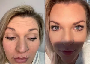 Botox Before and After Result at Kim Bell MedSpa in Kingston, TN