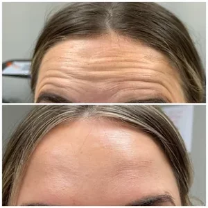 Botox Before and After Result at Kim Bell MedSpa in Kingston, TN
