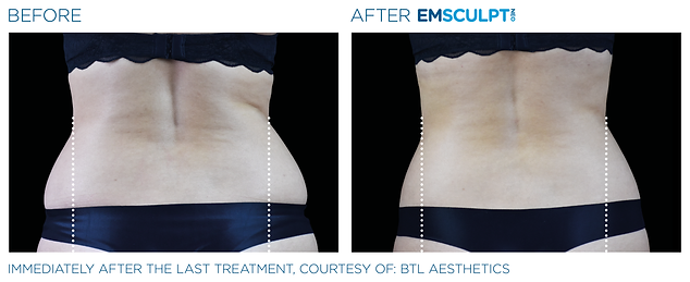 Emsculpt-Service-Before-After-Back-Kim-Bell-MedSpa-Kingston-TN