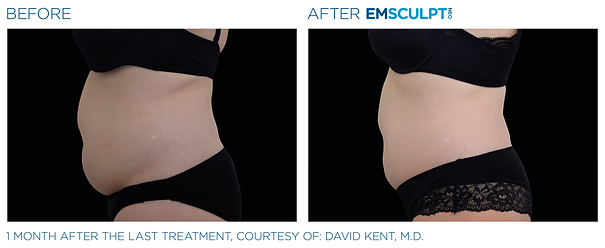 Emsculpt-Service-Before-After-Kim-Bell-MedSpa-Kingston-TN