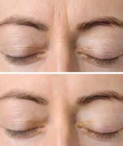 Botox Treatments Before After | Kim Bell Medspa in Kingston, TN