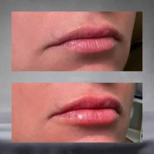 A Woman is Receiving Filler Services in Kingston, TN at Kim Bell MedSpa