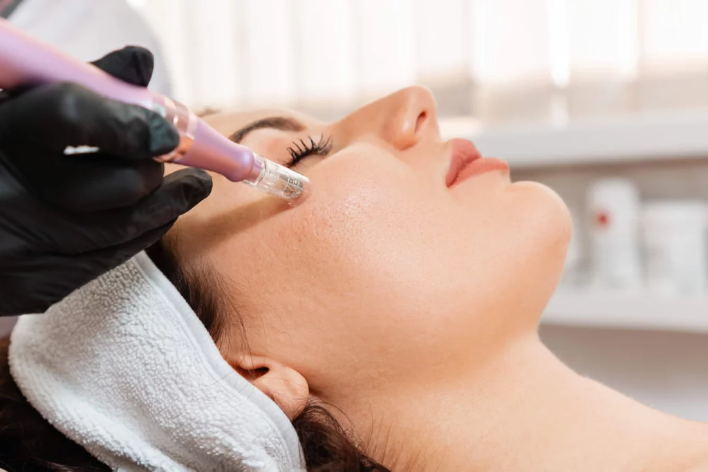 A Woman is Receiving Microneedling in Kingston, TN | Kim Bell MedSpa