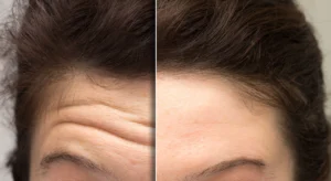 Botox Before and After Result at Kim Bell MedSpa in Kingston, TN