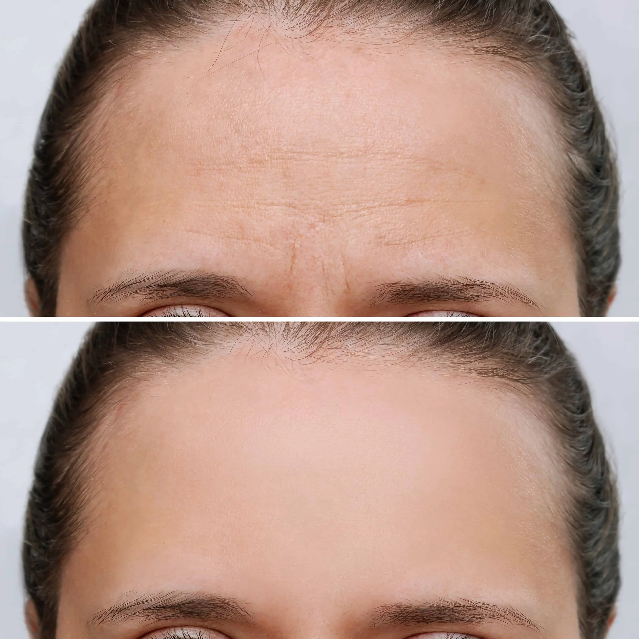 Botox Treatments at Kim Bell Medspa in Kingston, TN