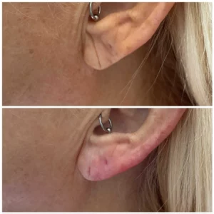 Ear Lobe at Kim Bell Medspa in Kingston, TN
