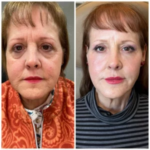 Full Face Rejuvenation at Kim Bell Medspa in Kingston, TN
