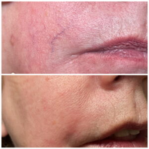 Laser Vein Removal at Kim Bell Medspa in Kingston, TN