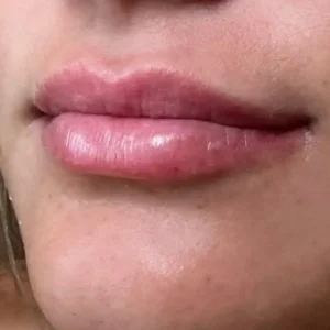 Lips Botox Treatments at Kim Bell Medspa in Kingston, TN