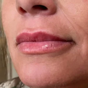 Lips Botox at Kim Bell Medspa in Kingston, TN