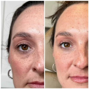Eye Filler before after | Kim Bell Medspa in Kingston, TN
