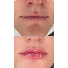 Lip Filler Before and After Result at Kim Bell MedSpa in Kingston, TN