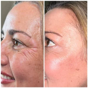 Botox at Kim Bell Medspa in Kingston, TN