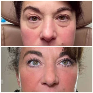 Cheeks before after | Kim Bell Medspa in Kingston, TN
