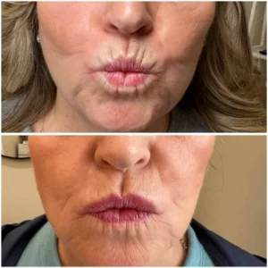 Smoker Lines Treatments | Kim Bell Medspa in Kingston, TN